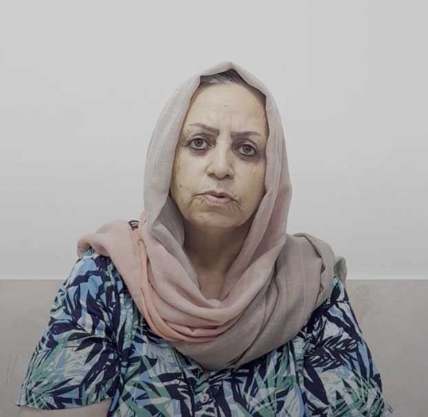 علت مراجعه ‌:تعویض مفصل زانو